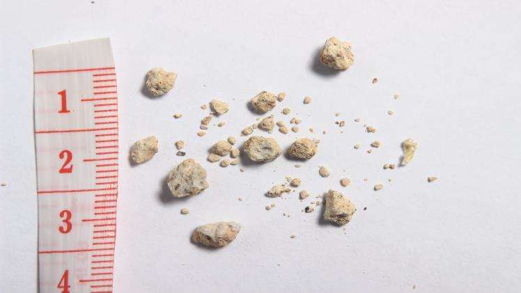 You are currently viewing Things to Know What Size of Kidney Stone Requires Surgery?