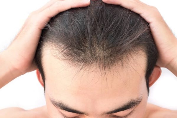 Is FUE hair transplant right for you?