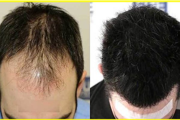 Consult the best dermatologists for hair loss treatment and skin issues.