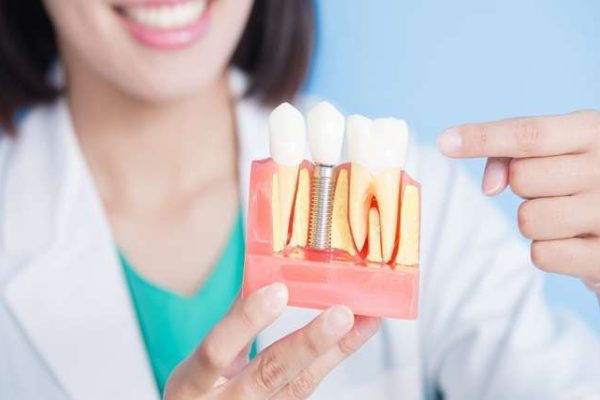 How to Choose a Qualified Dental Implant Specialist