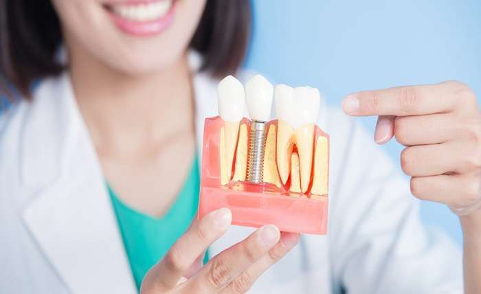You are currently viewing How to Choose a Qualified Dental Implant Specialist