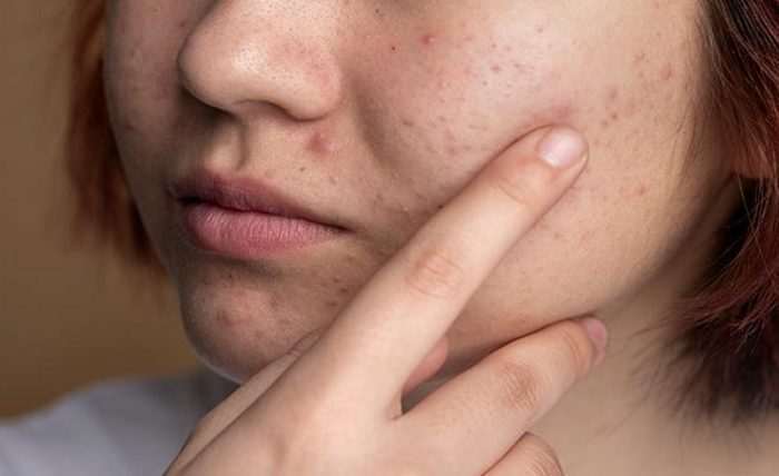You are currently viewing What Are Some Effective Ways to Treat Different Types of Acne at Home?