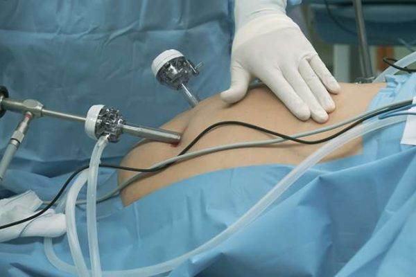 The Guide to Minimally Invasive Gastric Sleeve Surgery