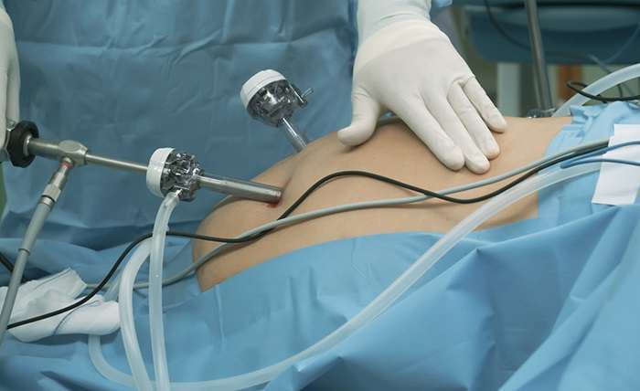 You are currently viewing The Guide to Minimally Invasive Gastric Sleeve Surgery